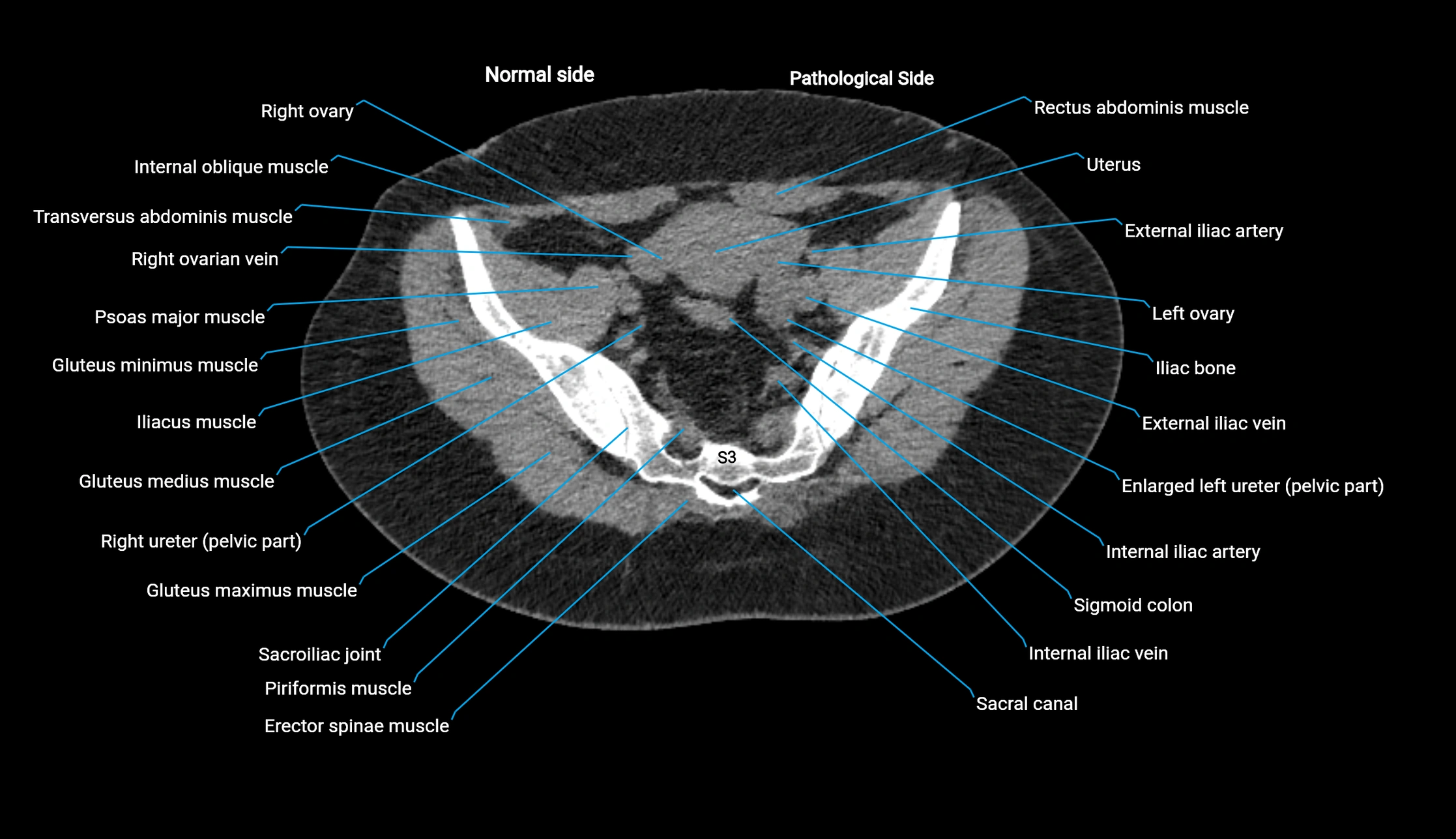 CT KUB axial cross sectional anatomy  radiology image -img-00201-00130.webp
